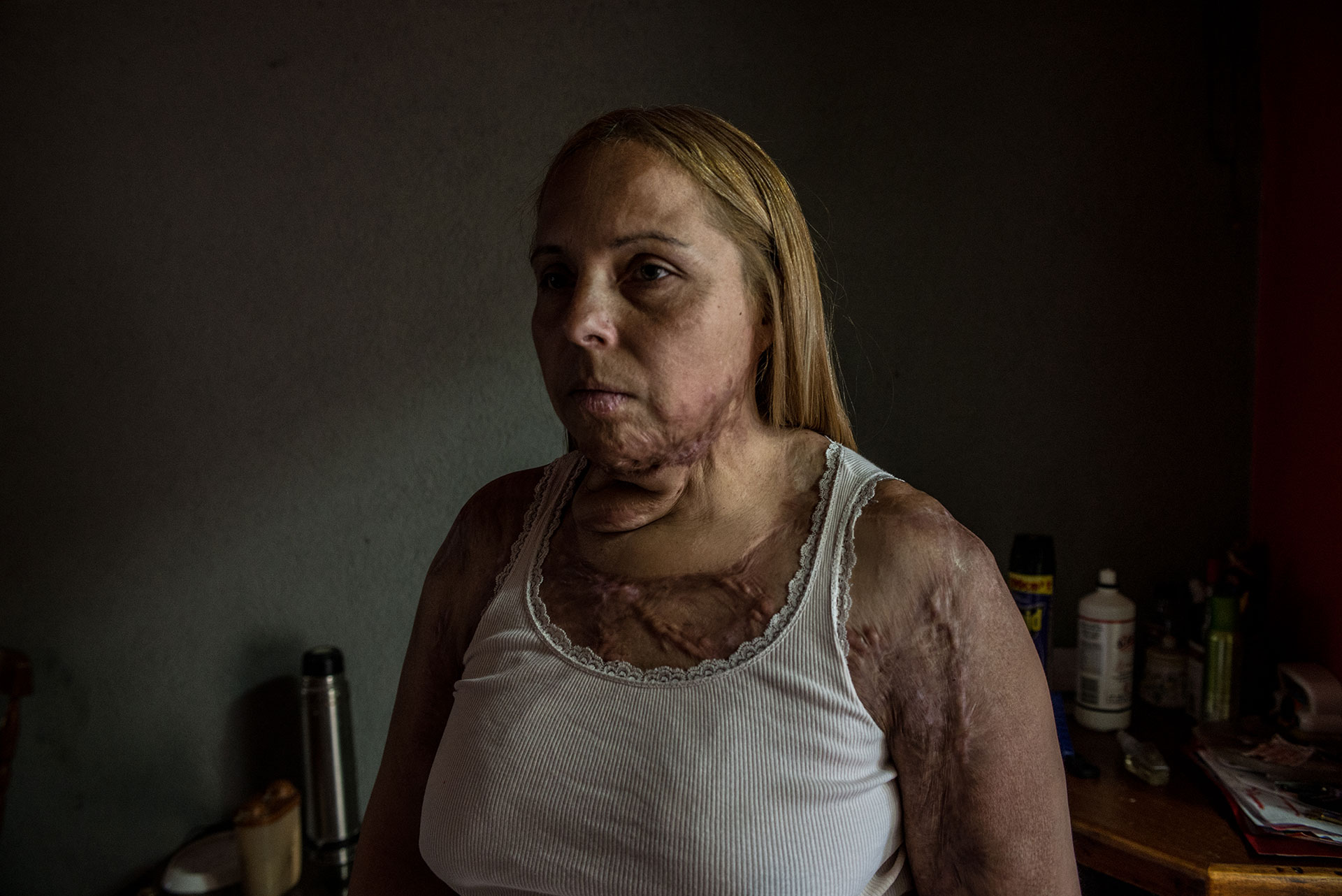 Karina Abregu fue quemada por su esposo, que es alcohólico, después de 11 años de violencia. Actualmente no puede trabajar debido a sus condiciones de salud y no recibe ningún tipo de ayuda del gobierno. Ella está luchando por sus derechos apoyada por su hermana Carolina.