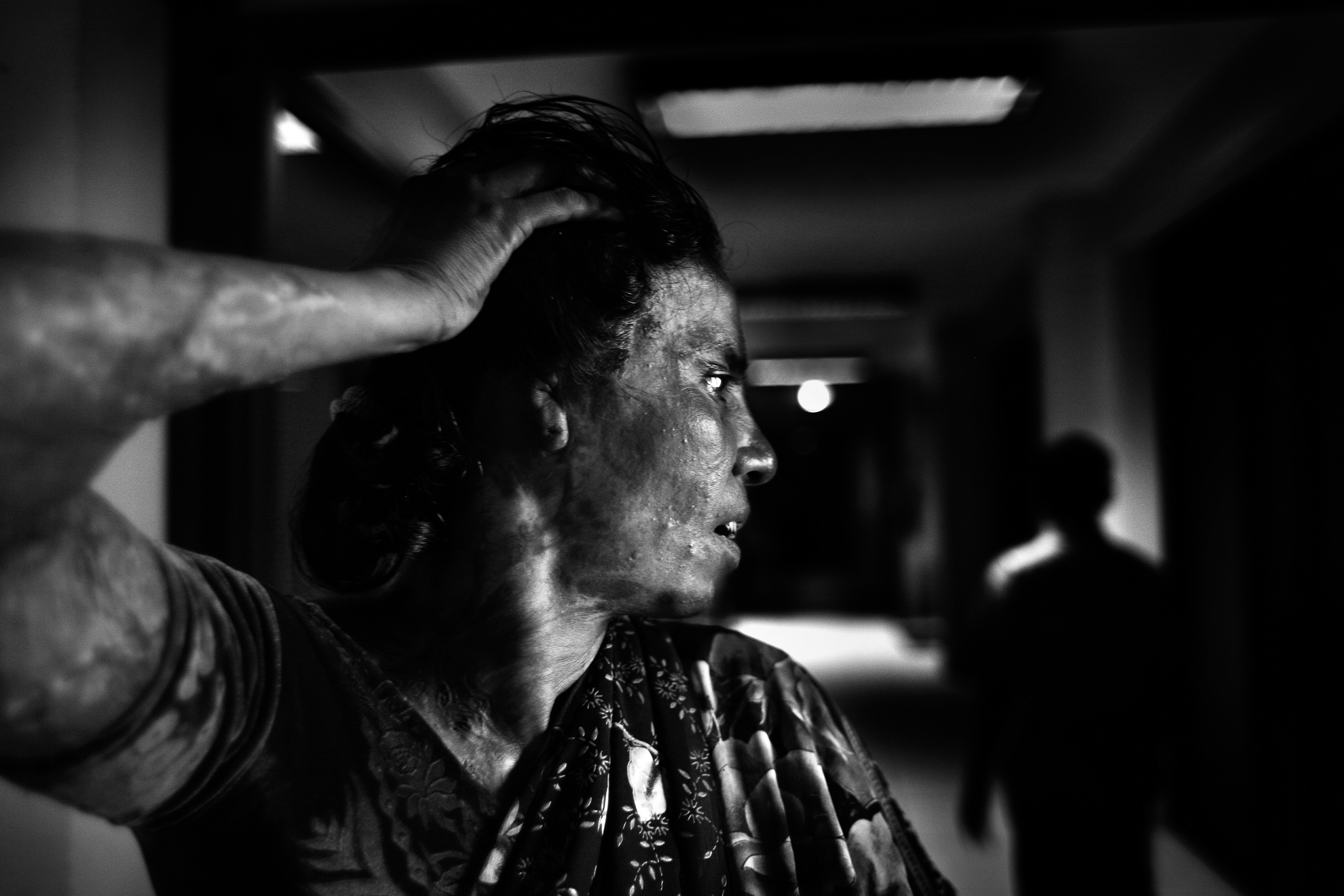 Rita Rani Das enseña las cicatrices en su rostro y cuello. Fue atacada por su primer marido después de haberse convertido al Islam y haberse unido en segundas nupcias con un musulmán, en abril de 2007.