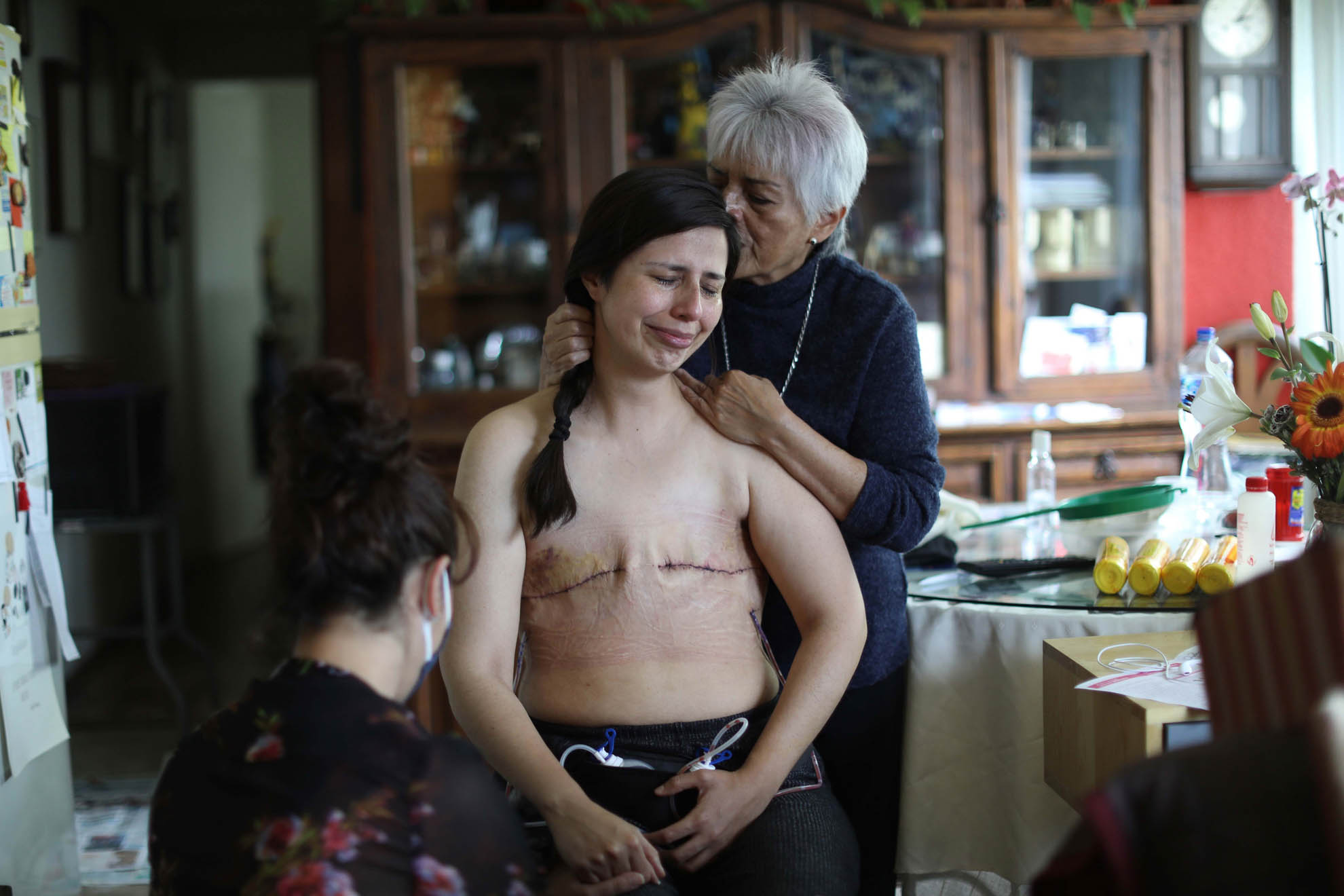 Sandra Monrroy de 36 años, 3 días después de someterse a una mastectomía bilateral a causa del cáncer de mama. Su amiga Gina Ramírez (i) y su madre Teresa Mandrujano (d) la acompañan en el momento de quitarse el vendaje que le fue colocado en su pecho. Ciudad de México (México), 08/07/2021.